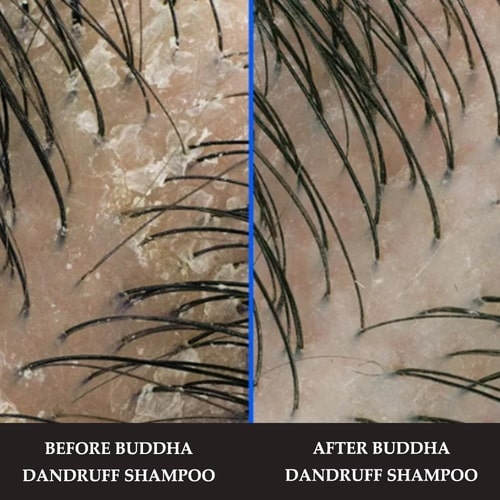 before and after use best dandruff shampoo for teenager