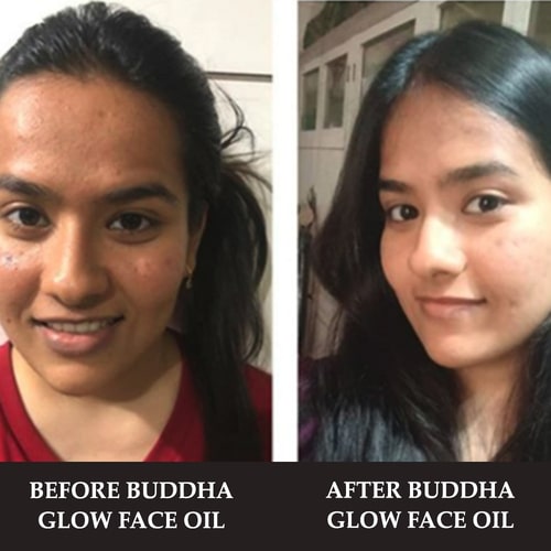 before and after used of Glow Face Oil for Teenagers (11 to 19 Years) 