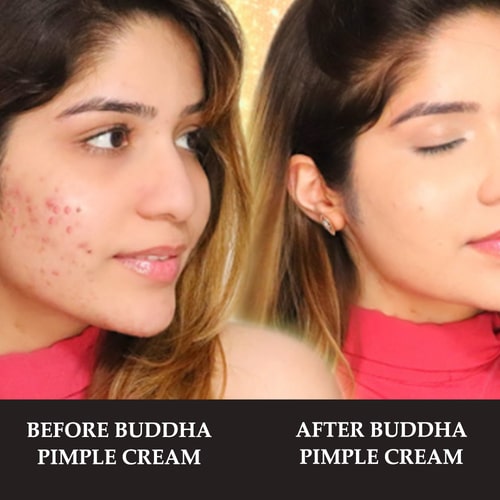 before and after use of Buddha Natural pimple cream for teenager