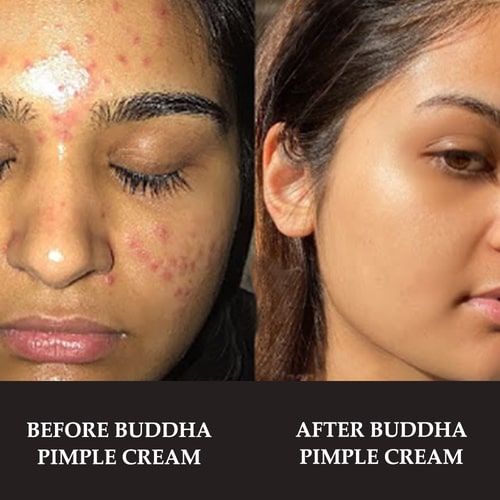 before and after use of best pimple cream for teens